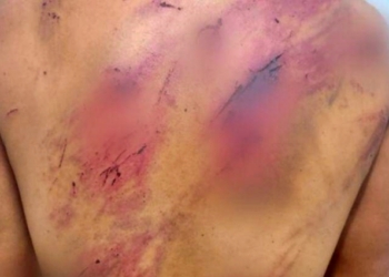 Mulher é espancada pelo marido até ficar com as costas feridas em Cuiabá