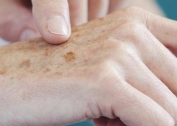 SES orienta a população sobre a prevenção e detecção precoce do câncer de pele