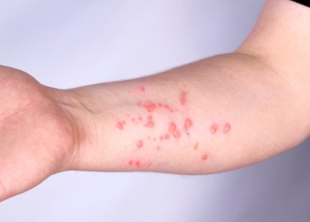 Cuiabá não registra casos de Mpox e mantém vigilância preventiva ativa