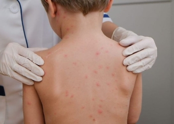 Cuiabá registra sete casos de meningite em 2026 e não confirma novos diagnósticos desde abril