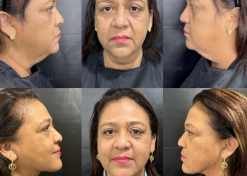 Confira qual o momento certo para fazer procedimentos após emagrecer